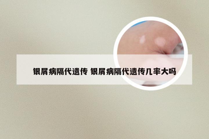 银屑病隔代遗传 银屑病隔代遗传几率大吗