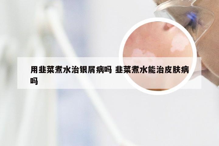 用韭菜煮水治银屑病吗 韭菜煮水能治皮肤病吗