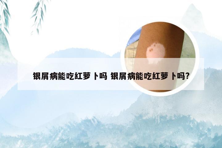 银屑病能吃红萝卜吗 银屑病能吃红萝卜吗?