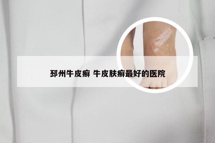 邳州牛皮癣 牛皮肤癣最好的医院