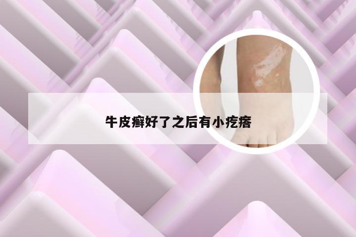 牛皮癣好了之后有小疙瘩