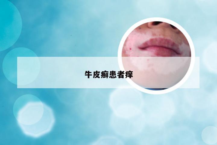 牛皮癣患者痒