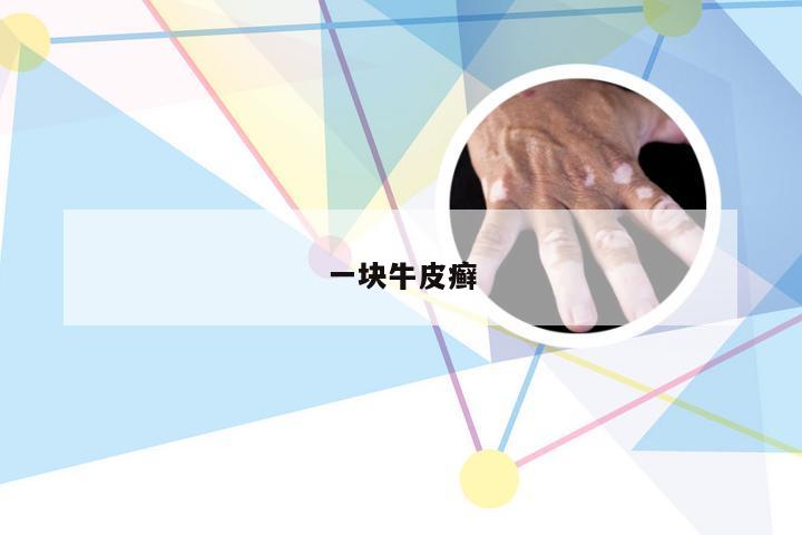 一块牛皮癣