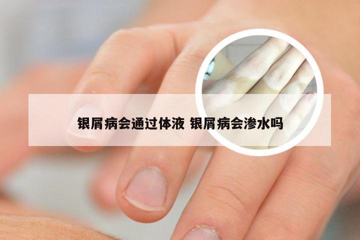 银屑病会通过体液 银屑病会渗水吗