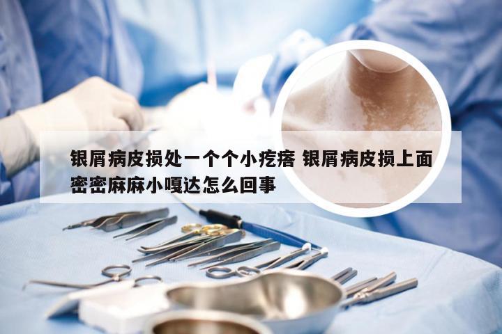 银屑病皮损处一个个小疙瘩 银屑病皮损上面密密麻麻小嘎达怎么回事