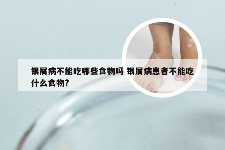 银屑病不能吃哪些食物吗 银屑病患者不能吃什么食物?