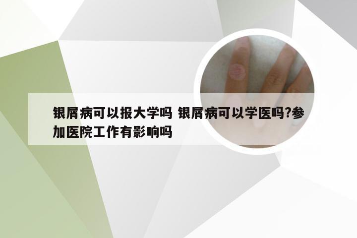 银屑病可以报大学吗 银屑病可以学医吗?参加医院工作有影响吗