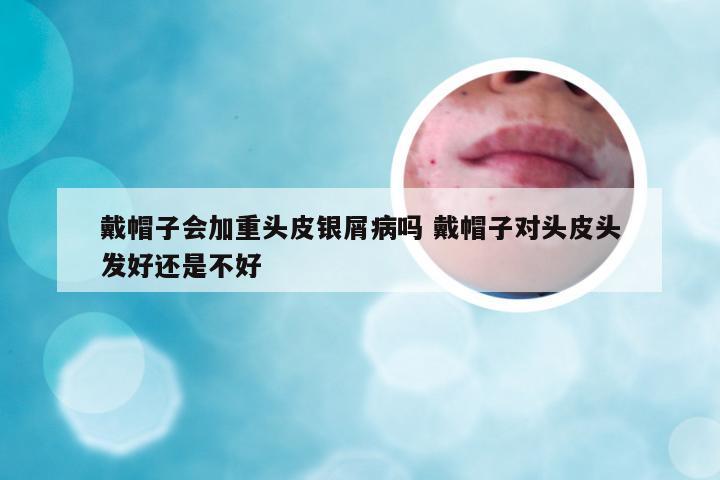 戴帽子会加重头皮银屑病吗 戴帽子对头皮头发好还是不好
