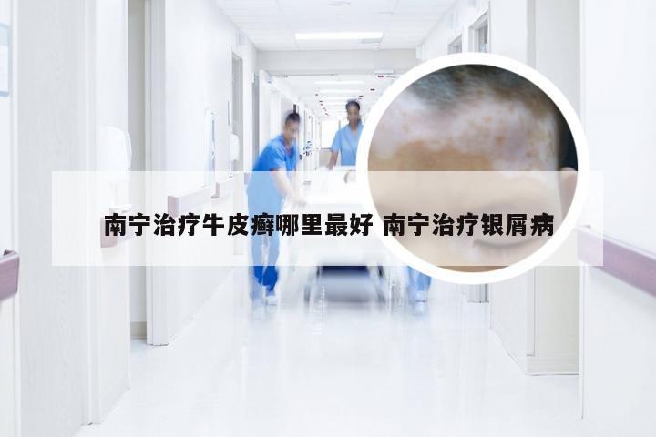 南宁治疗牛皮癣哪里最好 南宁治疗银屑病