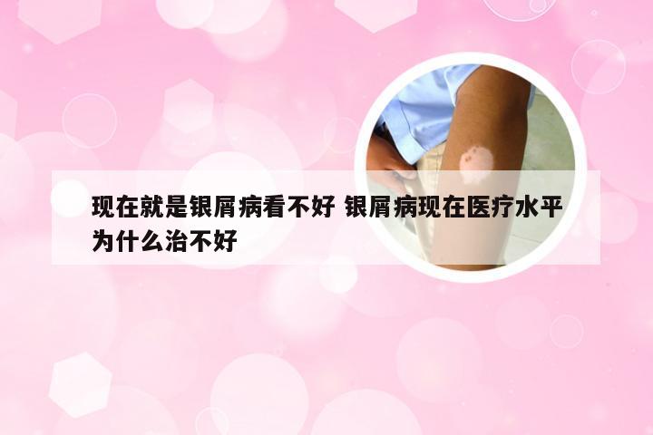 现在就是银屑病看不好 银屑病现在医疗水平为什么治不好
