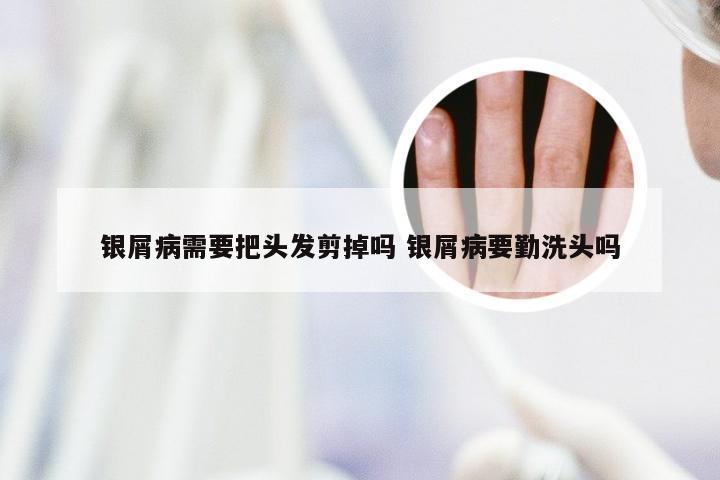 银屑病需要把头发剪掉吗 银屑病要勤洗头吗