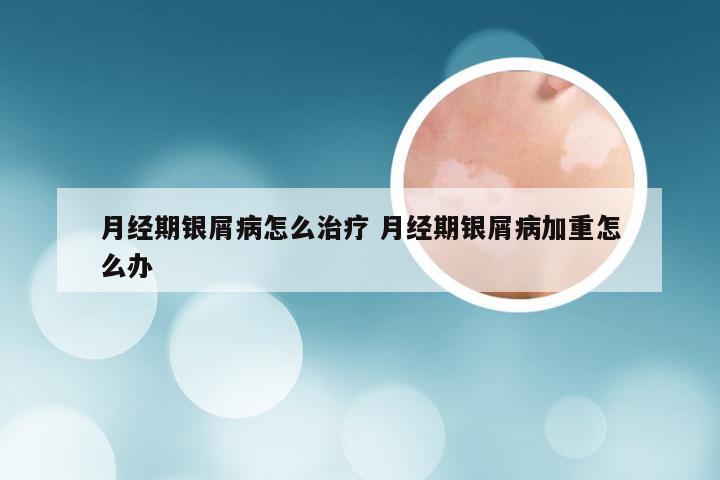 月经期银屑病怎么治疗 月经期银屑病加重怎么办