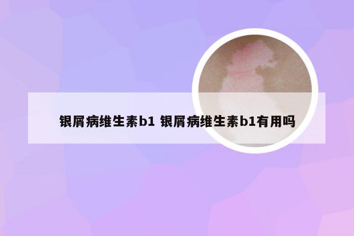 银屑病维生素b1 银屑病维生素b1有用吗