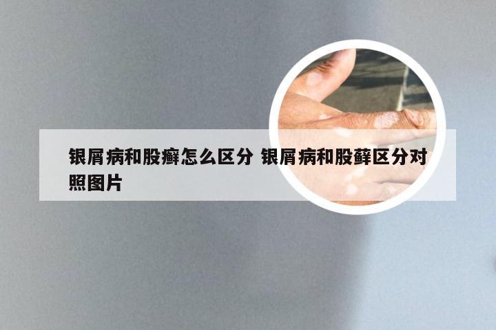银屑病和股癣怎么区分 银屑病和股藓区分对照图片