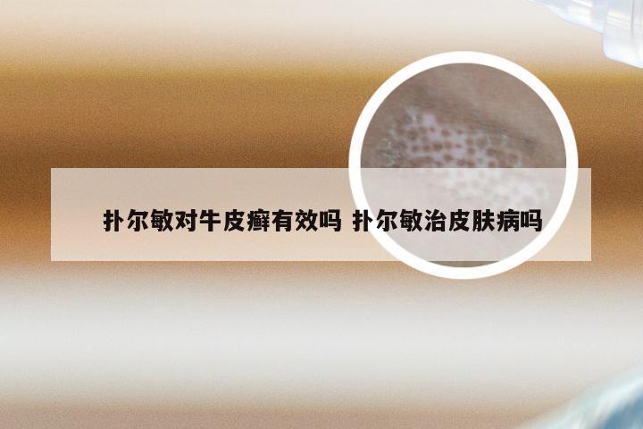扑尔敏对牛皮癣有效吗 扑尔敏治皮肤病吗