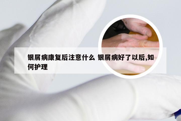 银屑病康复后注意什么 银屑病好了以后,如何护理