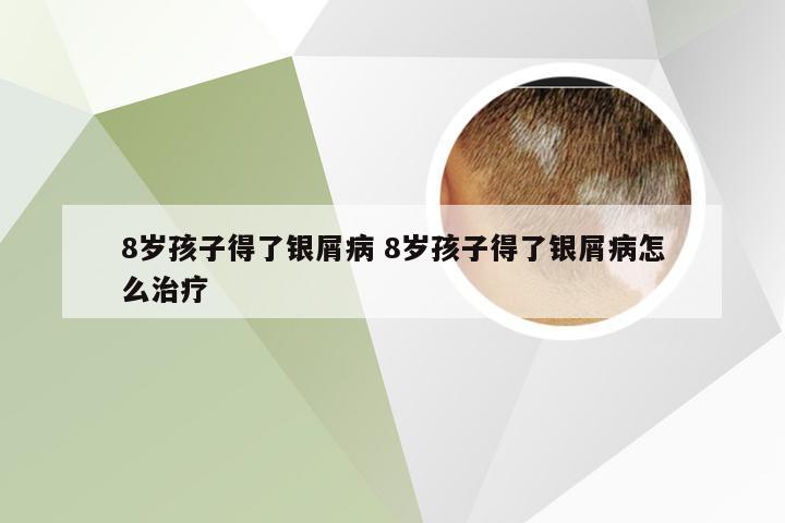 8岁孩子得了银屑病 8岁孩子得了银屑病怎么治疗