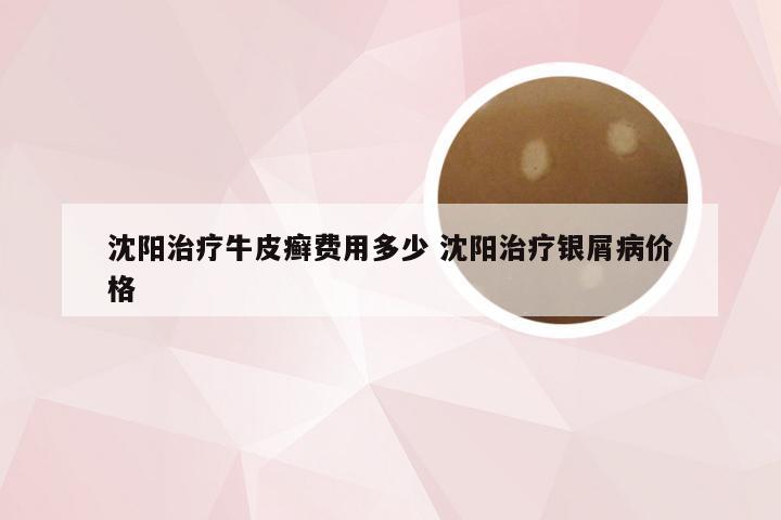 沈阳治疗牛皮癣费用多少 沈阳治疗银屑病价格