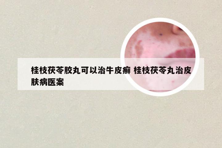 桂枝茯苓胶丸可以治牛皮癣 桂枝茯苓丸治皮肤病医案