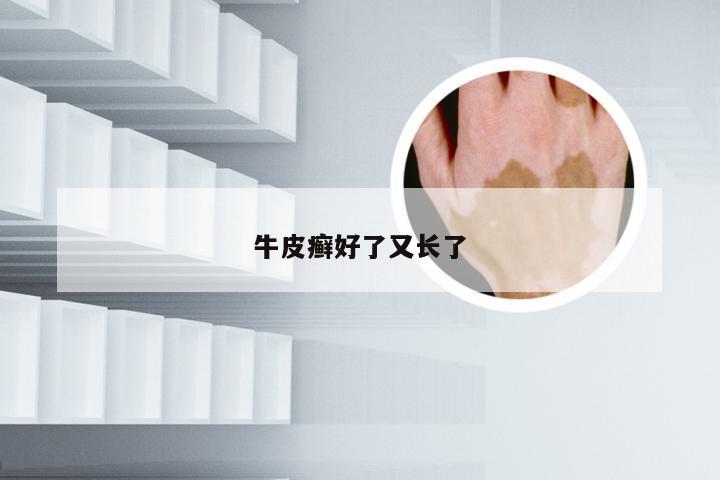 牛皮癣好了又长了