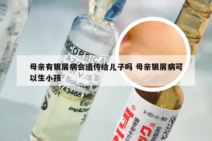 母亲有银屑病会遗传给儿子吗 母亲银屑病可以生小孩