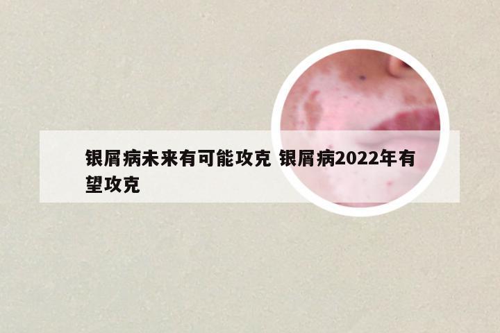 银屑病未来有可能攻克 银屑病2022年有望攻克