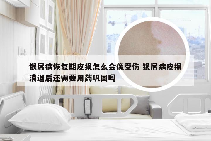 银屑病恢复期皮损怎么会像受伤 银屑病皮损消退后还需要用药巩固吗