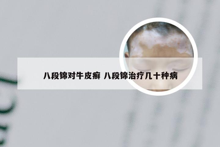 八段锦对牛皮癣 八段锦治疗几十种病