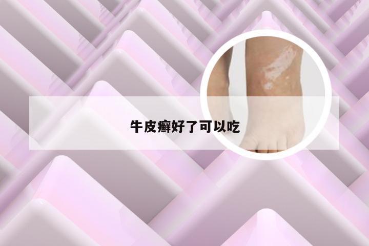 牛皮癣好了可以吃