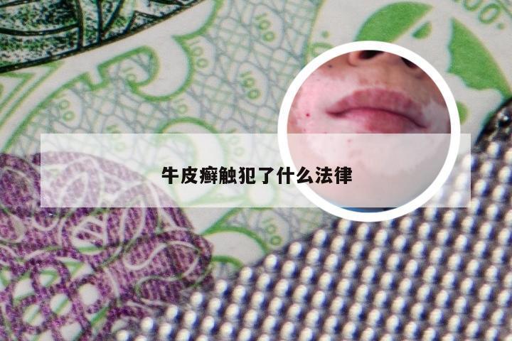 牛皮癣触犯了什么法律