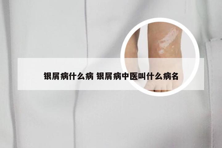 银屑病什么病 银屑病中医叫什么病名