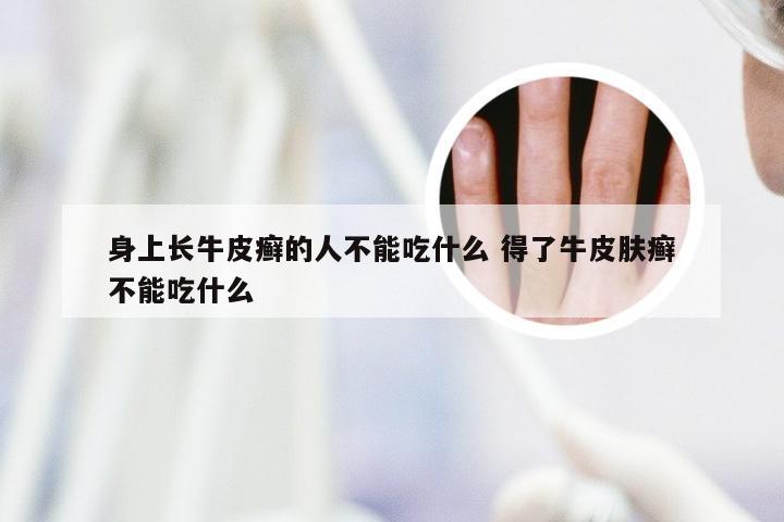 身上长牛皮癣的人不能吃什么 得了牛皮肤癣不能吃什么
