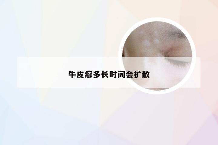 牛皮癣多长时间会扩散