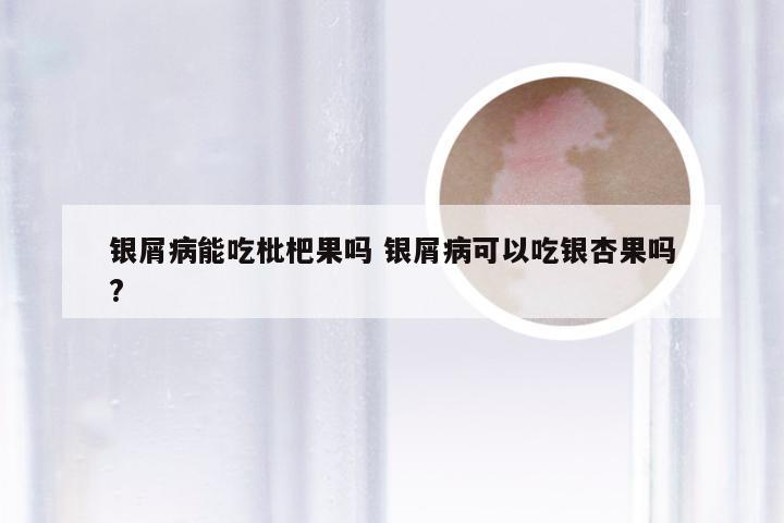 银屑病能吃枇杷果吗 银屑病可以吃银杏果吗?