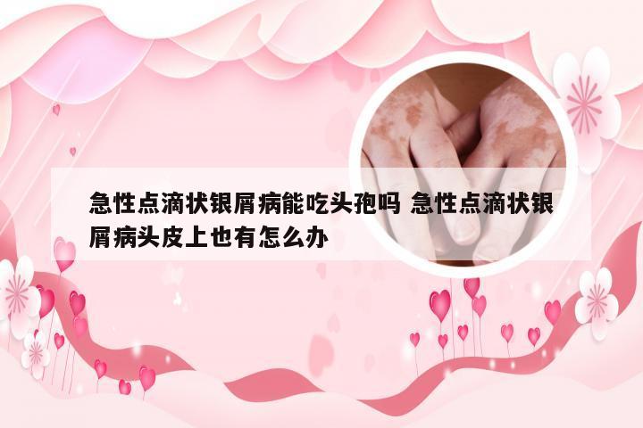 急性点滴状银屑病能吃头孢吗 急性点滴状银屑病头皮上也有怎么办
