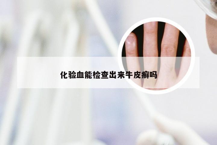 化验血能检查出来牛皮癣吗