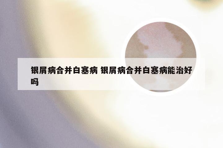 银屑病合并白塞病 银屑病合并白塞病能治好吗