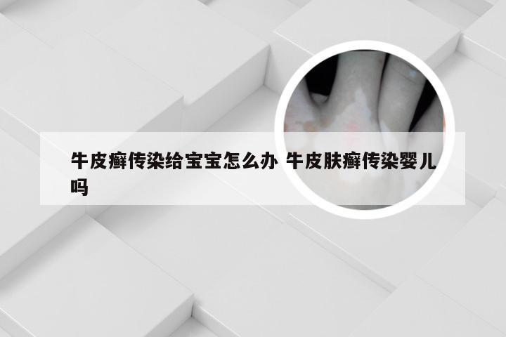 牛皮癣传染给宝宝怎么办 牛皮肤癣传染婴儿吗
