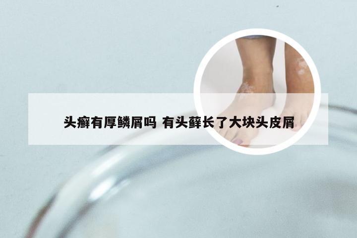 头癣有厚鳞屑吗 有头藓长了大块头皮屑