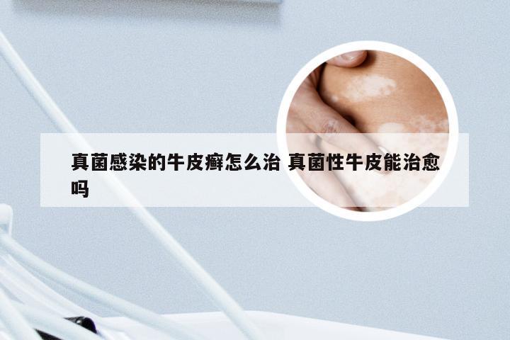 真菌感染的牛皮癣怎么治 真菌性牛皮能治愈吗