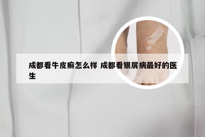 成都看牛皮癣怎么样 成都看银屑病最好的医生