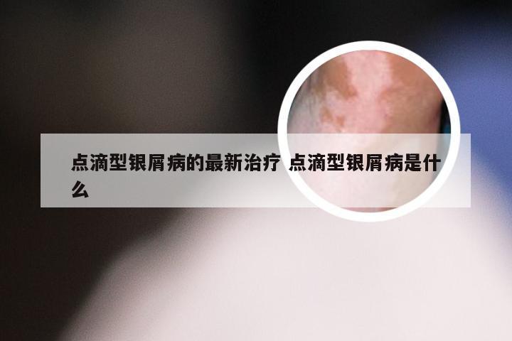 点滴型银屑病的最新治疗 点滴型银屑病是什么