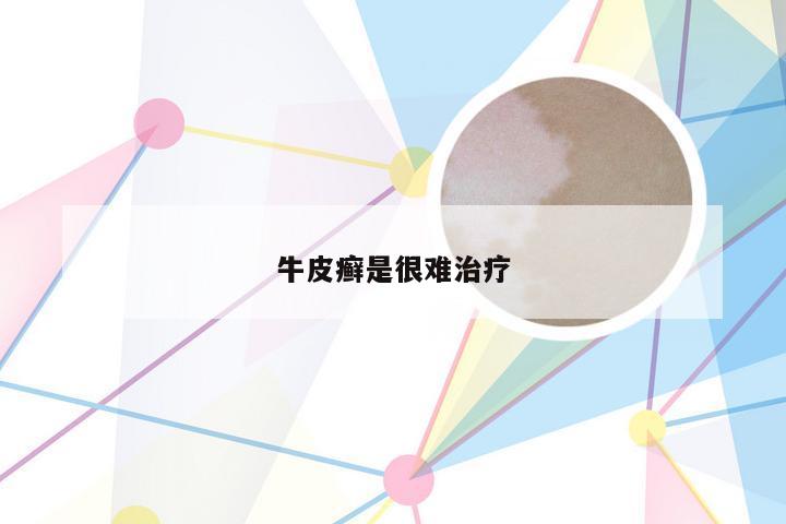 牛皮癣是很难治疗