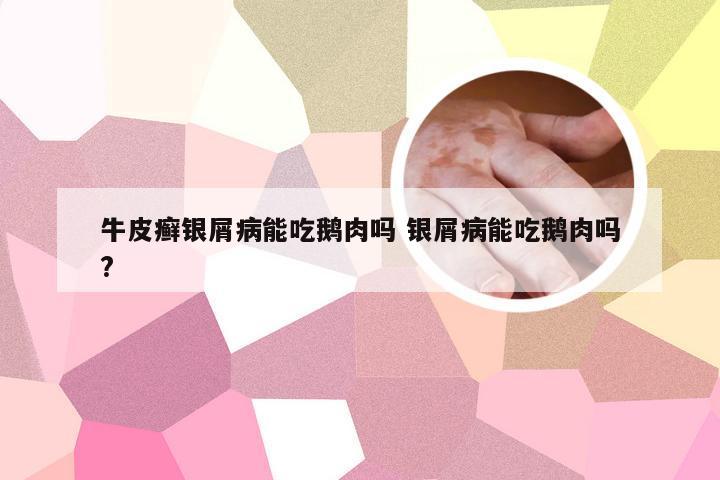 牛皮癣银屑病能吃鹅肉吗 银屑病能吃鹅肉吗?