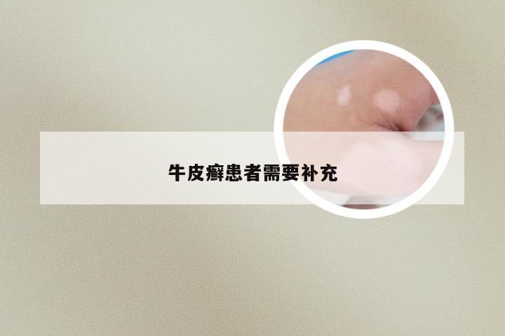牛皮癣患者需要补充