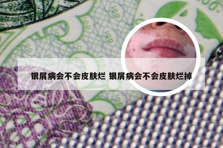 银屑病会不会皮肤烂 银屑病会不会皮肤烂掉