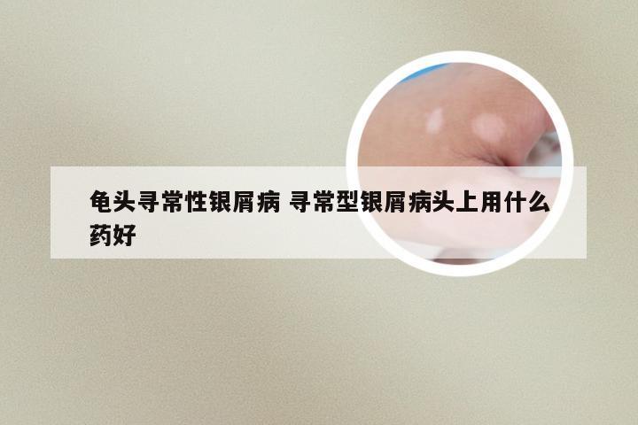 龟头寻常性银屑病 寻常型银屑病头上用什么药好