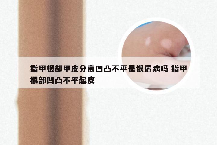指甲根部甲皮分离凹凸不平是银屑病吗 指甲根部凹凸不平起皮