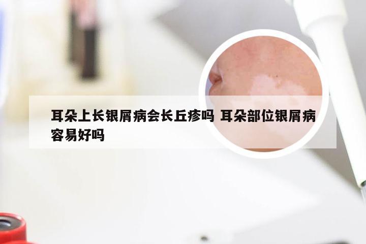 耳朵上长银屑病会长丘疹吗 耳朵部位银屑病容易好吗