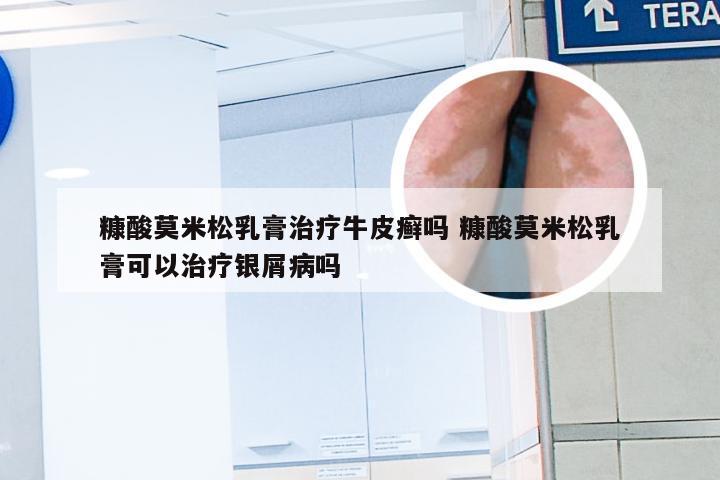 糠酸莫米松乳膏治疗牛皮癣吗 糠酸莫米松乳膏可以治疗银屑病吗